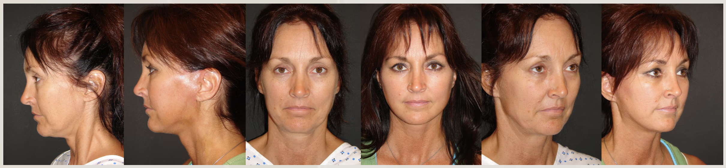At Mommy Makeover Tijuana a facelift is a surgical procedure that involves lifting, trimming, and tightening the skin and tissues of the lower face and neck via discreet incisions.