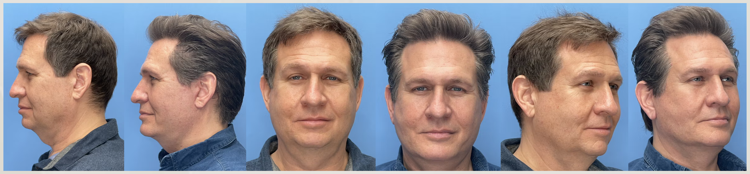 At Mommy Makeover Tijuana a facelift is a surgical procedure that involves lifting, trimming, and tightening the skin and tissues of the lower face and neck via discreet incisions.