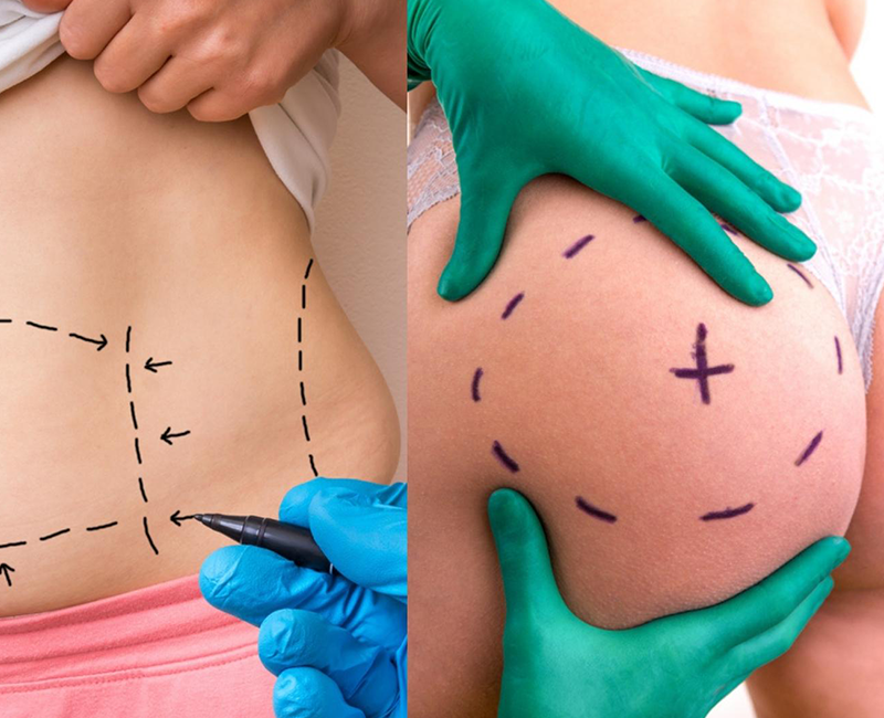 The term ‘mommy makeover’ refers to a combination of procedures that can be done during the same surgery — which can include a Brazilian butt lift (BBL).